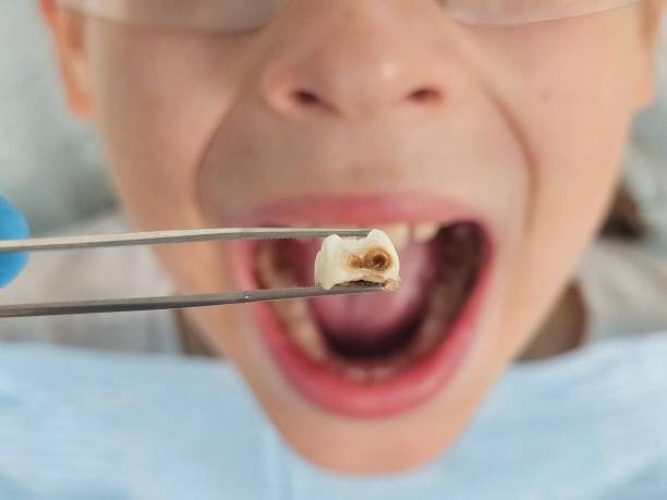 Best Emergency Wisdom Teeth Removal in Millersburg, PA
